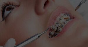What Is the Best Age to Start Orthodontic Treatment?